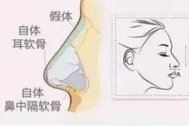 隆鼻有哪些副作用？小心这5大后遗症等着你图片