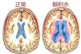 脑子里真的会“进水”吗？图片