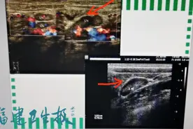 福州7岁女童腹痛被送急诊！家长警惕！这种病春季高发图片