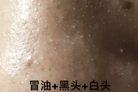 亲测有用！我的万年黑头，终于被TA连根拔起了图片