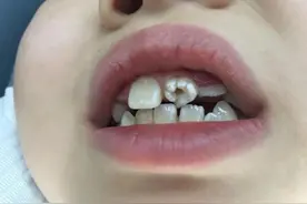 八岁女童牙长成一朵花诊断后竟是额外牙 专家提醒：要养成定期口腔检查的习惯图片