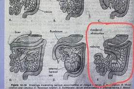 分娩半年后小肠“出轨”，28岁年轻妈妈因罕见内疝引发小肠扭转图片