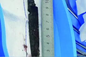 断刃藏颅脑26年 老人从青海来济成功手术图片