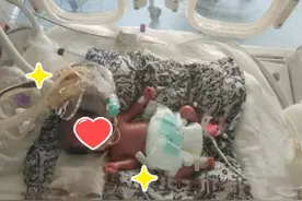 出生仅1斤多重的早产娃连闯生死关，体重日渐增长图片