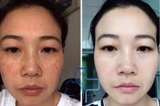 经常喝胶原蛋白有什么副作用 2026年经常喝胶原蛋白有什么副作用和危害