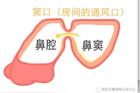 头痛系列——急性鼻窦炎图片