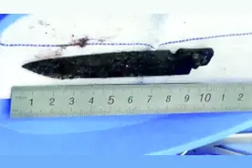 10厘米尖刀藏76岁老人脑内26年 医生都觉得不可思议图片