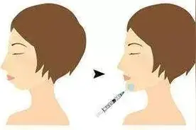 玻尿酸的作用是什么？注射完之后有哪些方面是需要注意的图片