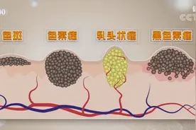 身上黑痣去不对，小心恶化变肿瘤图片