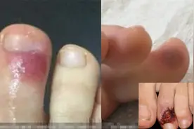 新冠病毒可致脚趾起痘？西班牙专家：或为早期特殊症状图片