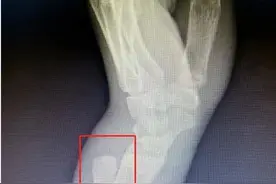 疫期宅家少运动胖了十多斤，体育特长生复课首日骑车倒地骨折图片