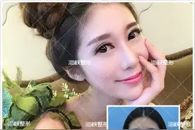 明明打了瘦脸针，脸为什么还这样大？图片