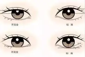 开眼角不仅可以让眼睛变大，还有这几个好处你没想到图片