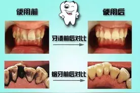 花钱就是省钱，在洗牙这件事情上说的一点都没错图片