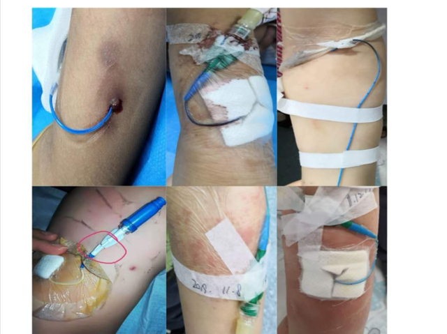 看着留置PICC挺吓人？不怕，这五大优点和注意事项来了解一下