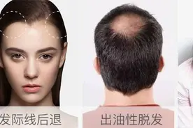 为发际线后移烦恼？试试来自德国的防脱发“黑科技”图片