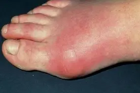 三高都知道，第四高您知道吗？不但引起脚疼，还导致心血管疾病图片