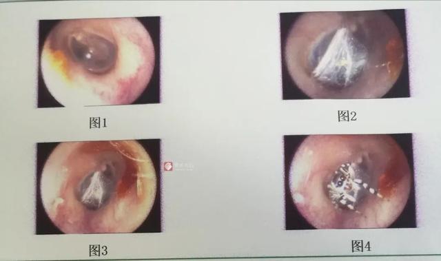 蜘蛛进耳朵里怎么办