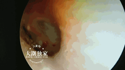 蜘蛛进耳朵里怎么办