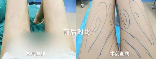 济南艺星大腿/腰腹环吸低￥6800！上臂吸脂￥4800