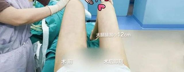 济南艺星大腿/腰腹环吸低￥6800！上臂吸脂￥4800