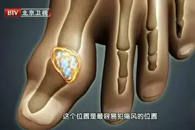 痛风的根本原因原来是“它”！别盲目追求降尿酸了……图片
