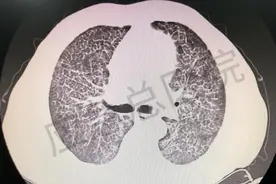 应急总医院：特殊时期的全肺灌洗图片