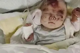 贵州3个月女婴疑被老鼠咬伤，头部见骨、3根手指被咬断图片