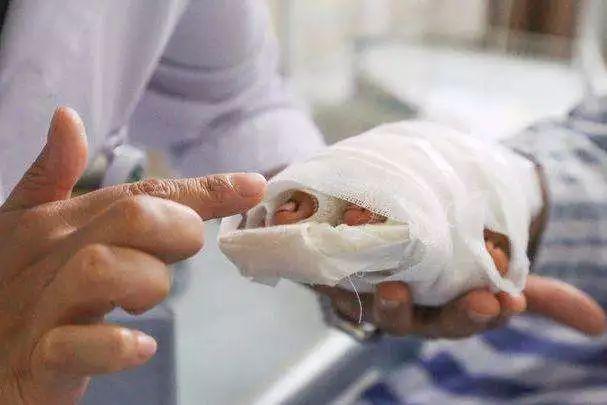 男子深夜加班被切断两根手指！只剩一丝皮！医生摇头说……