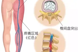 腰间盘突出腰疼腿麻怎么办？教你几个妙招，效果还挺好的图片