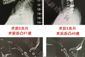 花季少女脖子后凸超90度 患的是罕见遗传病图片