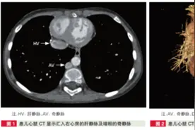 侧开胸、不停跳实施肝静脉-奇静脉连接术！阜外医院闫军团队巧治复杂先心病图片