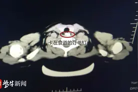 凶险！10岁男童误吞订书钉胃镜下2分钟取出化险为夷图片