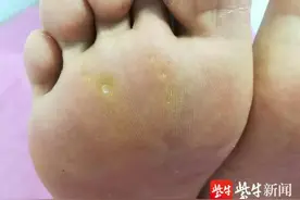 像鸡眼又不是鸡眼，脚底长了这种茧不但疼还会传染图片