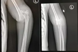 小女孩摔骨折不愿手术 正骨手法5分钟复位图片