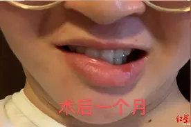 小姐姐想变美做面部吸脂术成歪嘴 卫健部门：正调查医生的手术资质图片