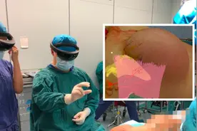 医生“透视”病人体内血管，混合现实MR技术国际首次引导完成游离皮瓣切取术图片