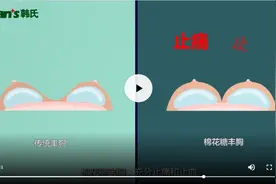 假体隆胸后遗症—术后假体会发生位移吗？图片