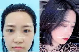 隆鼻后鼻尖发红？这是怎么回事？正常现象还是隆鼻后遗症？图片