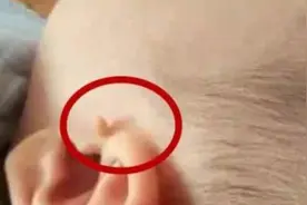 耳前的“拴马桩”您了解多少？图片