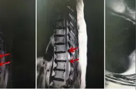 脊柱科成功为又一例高龄疑难胸脊髓变性压迫神经患者实施手术图片
