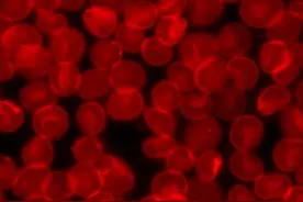 研究发现异常小的红细胞可能是新型的癌症早期生物标记物图片