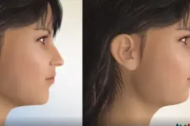 脸型不美怎么拯救？堪称换脸的正颌手术是什么？图片