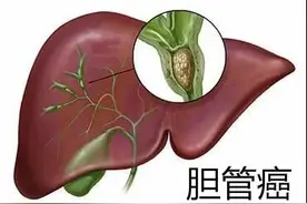 阿替利珠单抗联合考比替尼，免疫疗法治疗胆管癌前景可期图片