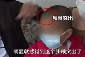 家长心碎！湖南永兴出现多名“大头娃娃”，都跟喝了这种“奶粉”有关图片