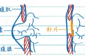 腹腔镜下治疗疝气的四大优势图片