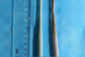 男孩吞4把牙刷一周后呕吐肚子疼，医生套住牙刷头从食道取出图片