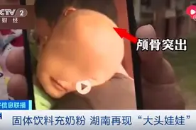 痛心！湖南出现“大头娃娃”，患病孩子都喝了这种“特殊奶粉”→图片