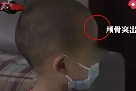 郴州“大头娃娃”再现，免疫学专家：长期食用固体饮料，无法保障婴儿成长所需成分图片