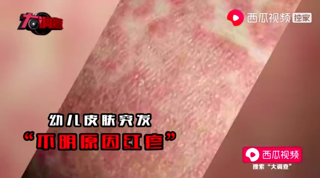 湖南出现多名「大头娃娃」，他们都喝了这款「假奶粉」